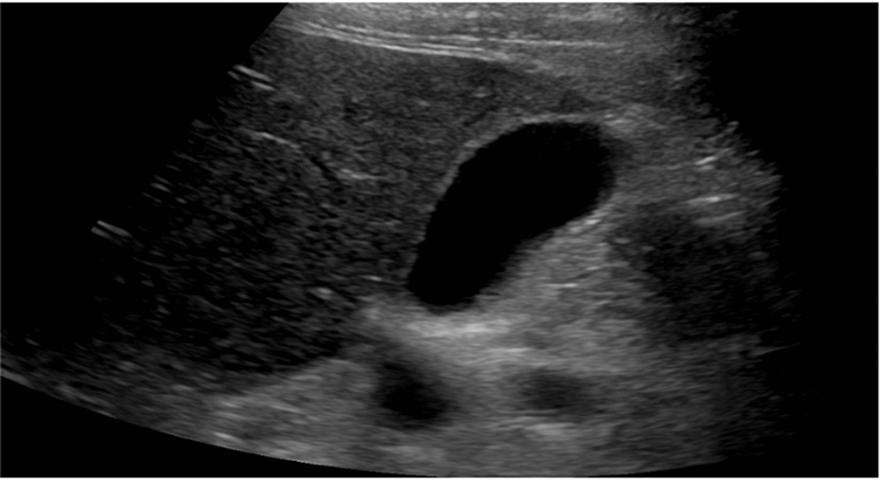 Ultrasound - right upper quadrant - reveals - shows - unnoticeable - gallbladder - without evidence - gallstones - or wall thickening.  -