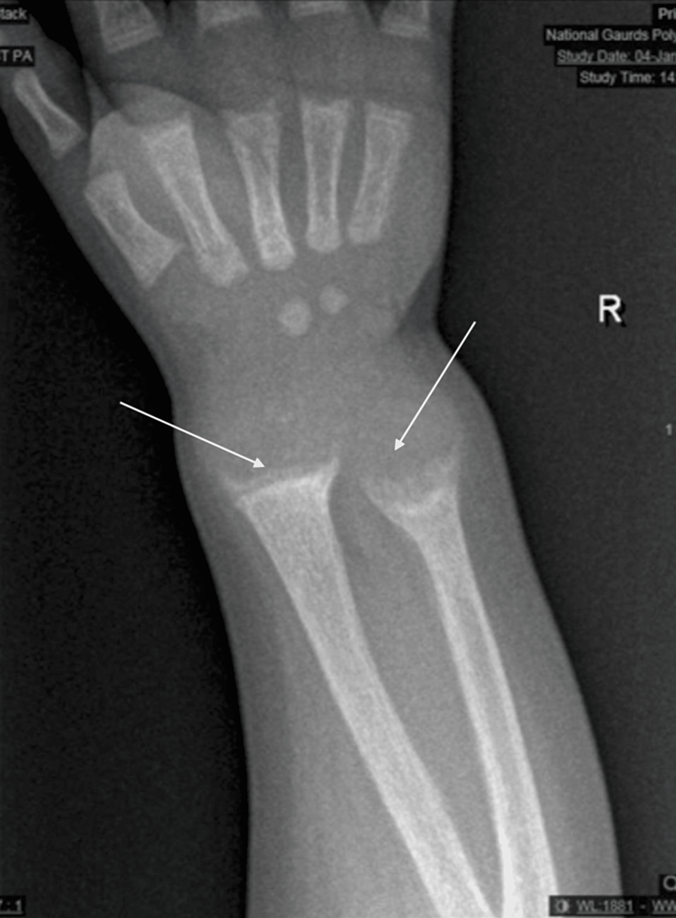X-ray-of-the-wrist-showing-fraying,-widening,-and-cupping-of-the-metaphyseal-ends-of-both-the-ulna-and-radius-bones.