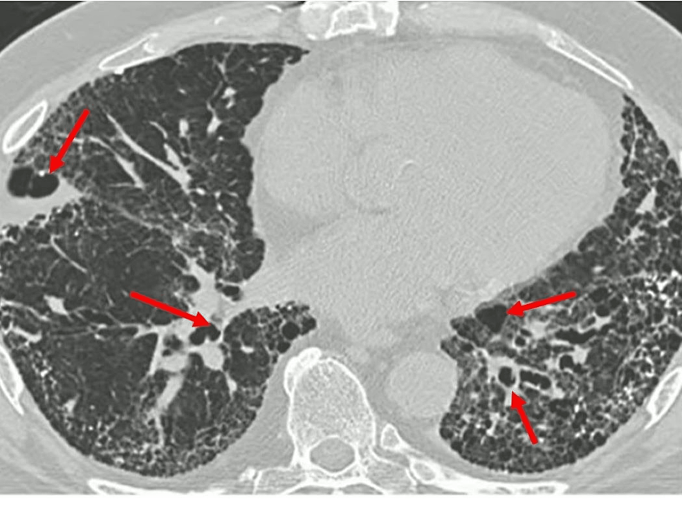 High-resolution-CT-chest-demonstrating-ground-glass-opacities,-airway-dilation,-and-thickened-airways-manifesting-bronchiectasis.