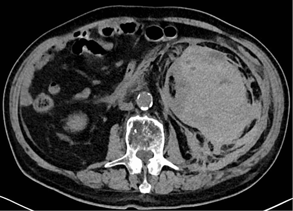 a-case-of-spontaneous-perinephric-hematoma-from-rivaroxaban-cureus