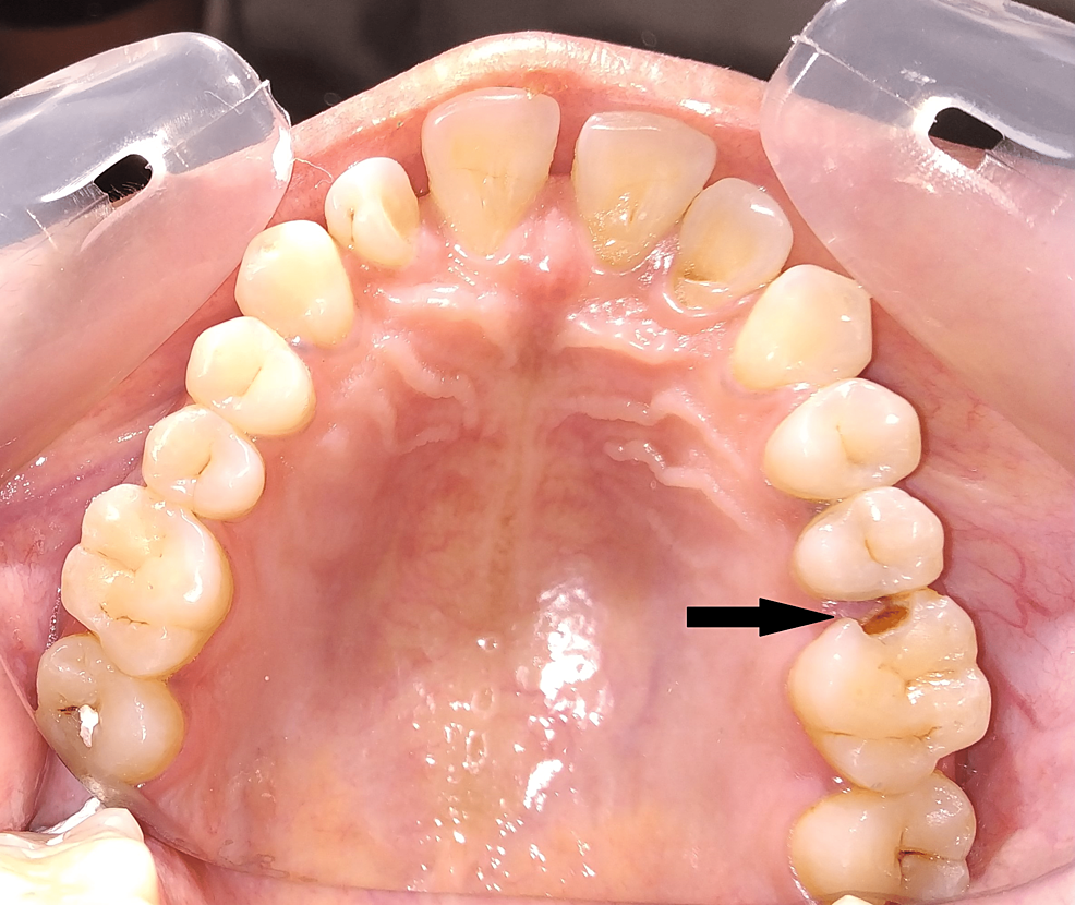 cureus-ceramic-inlays-a-case-report