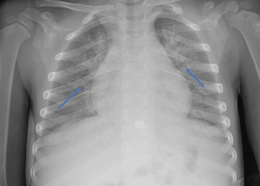 Chest-radiograph-of-a-three-year-old-patient-with-Multisystem-Inflammatory-Syndrome-in-Children-showing-diffuse-hazy,-peri-hilar-densities-and-peri-bronchial-cuffing-(blue-arrows)