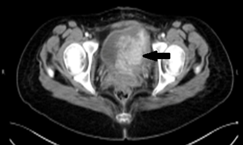 A Large Inflammatory Myofibroblastic Tumor of the Urinary Bladder in a Parturient Treated by Partial Cystectomy: Case Report and Literature Review 