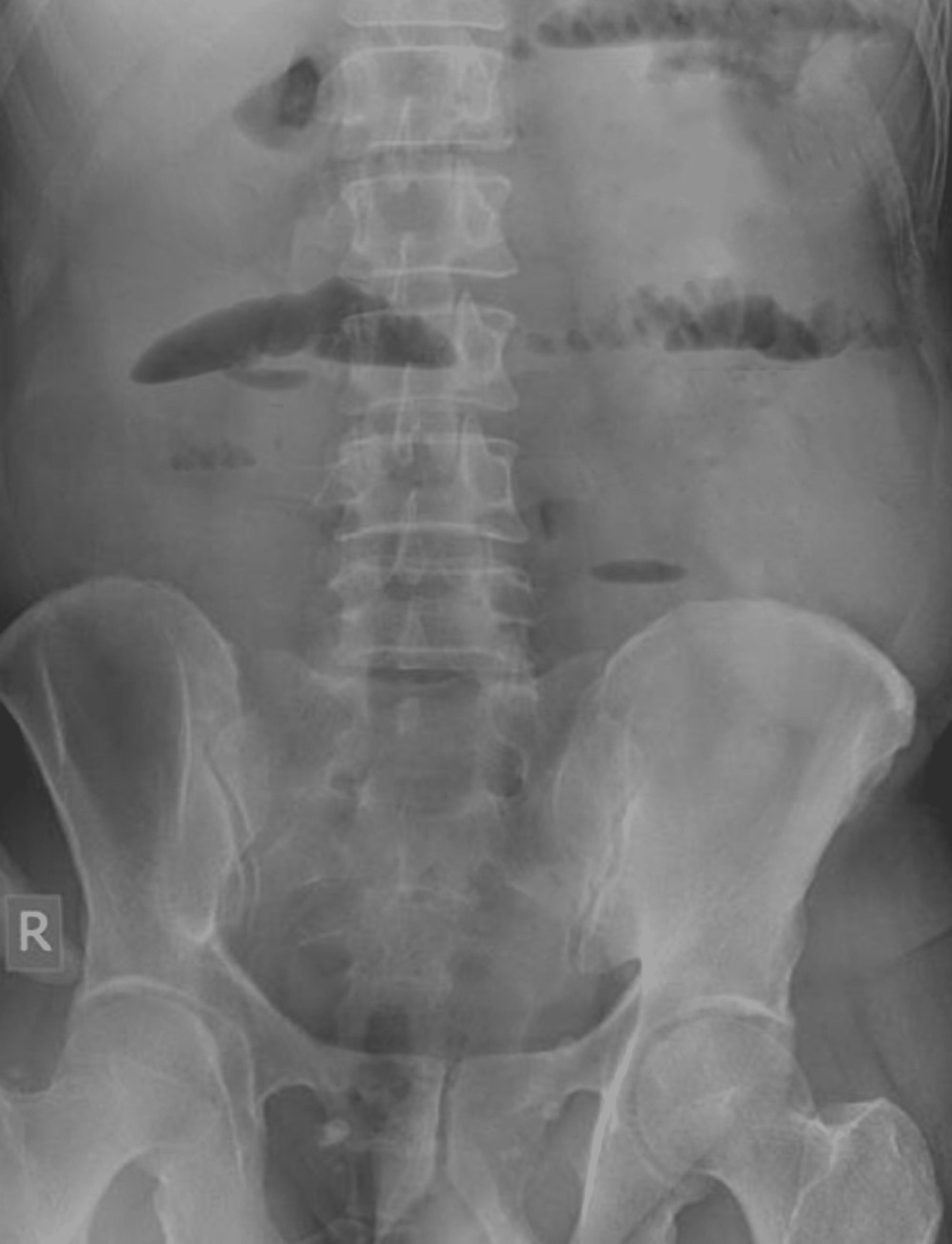 Cureus Ileocecal Intussusception With Lipoma As A Lead Point Leading