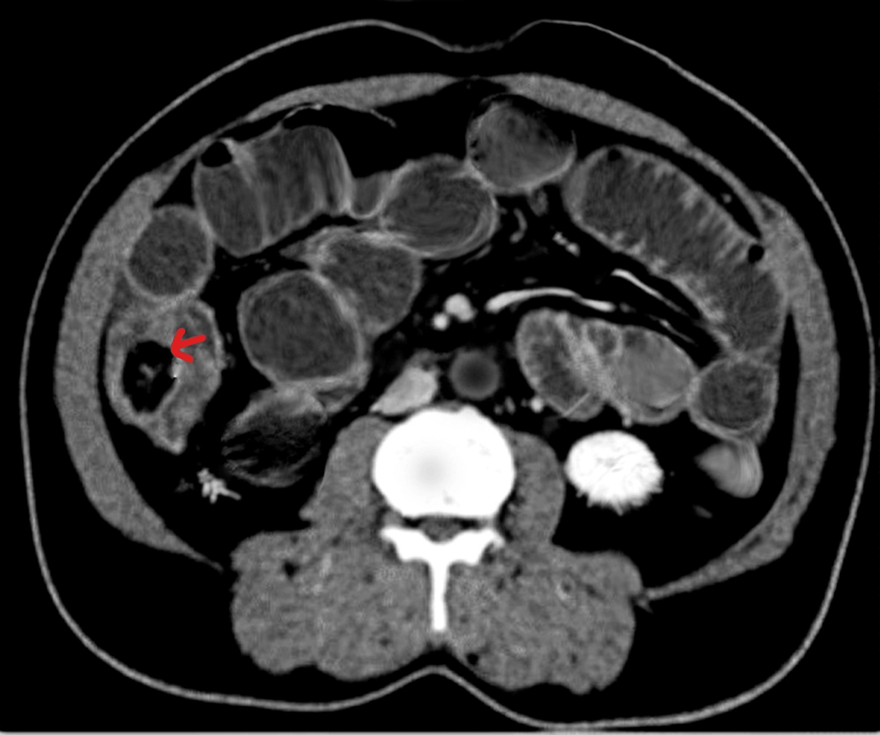 Cureus Ileocecal Intussusception With Lipoma as a Lead Point Leading