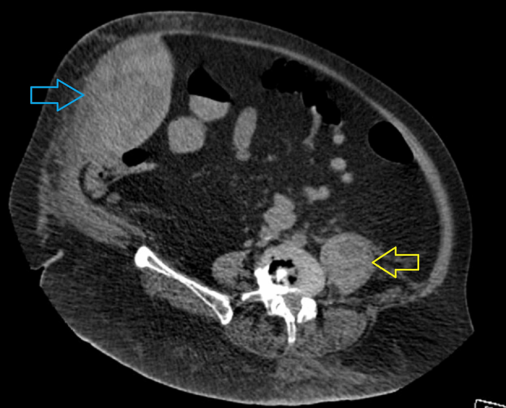 A Case Of Spontaneous Multiple Abdominal Wall Hematomas In A Covid