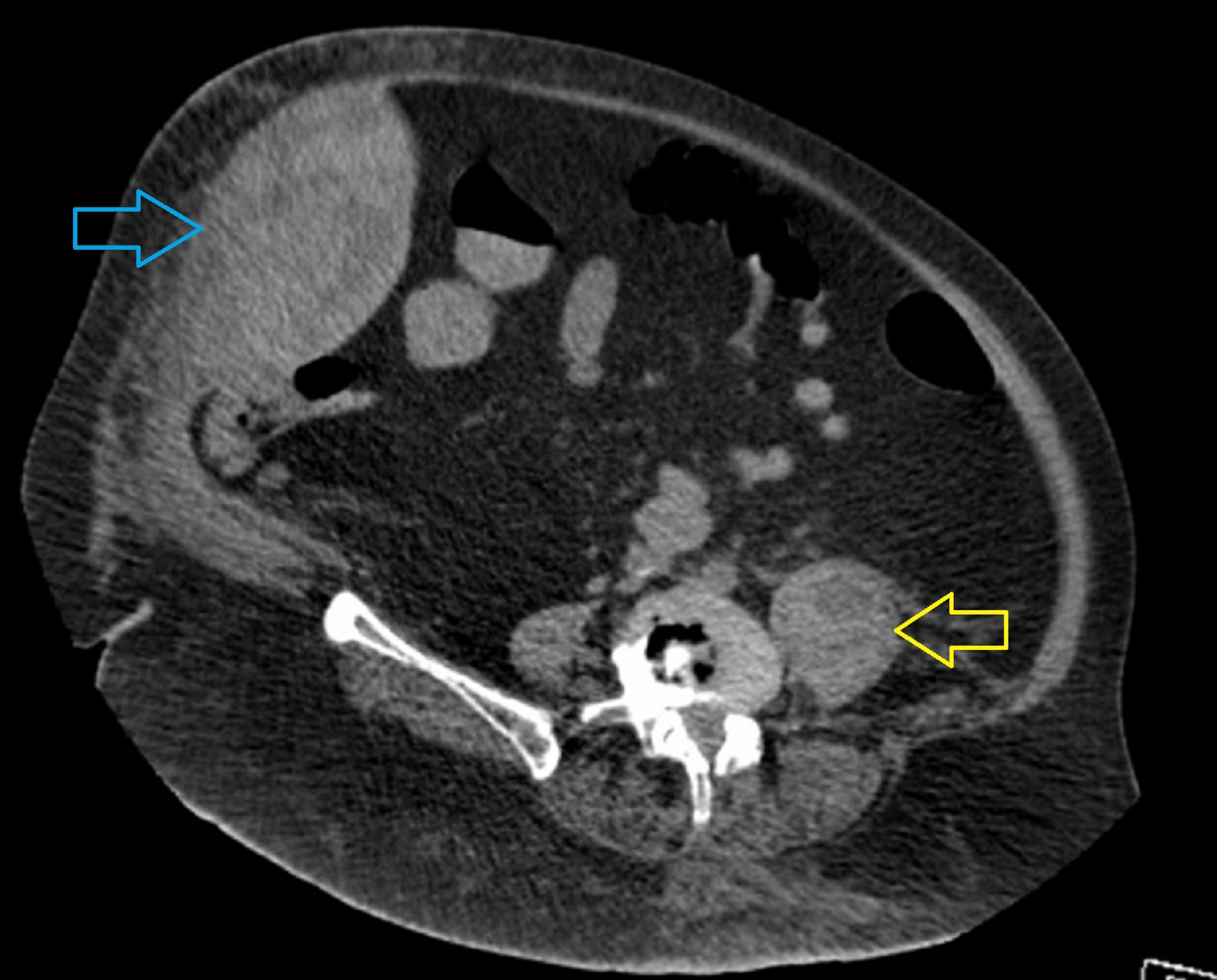 cureus-a-case-of-spontaneous-multiple-abdominal-wall-hematomas-in-a