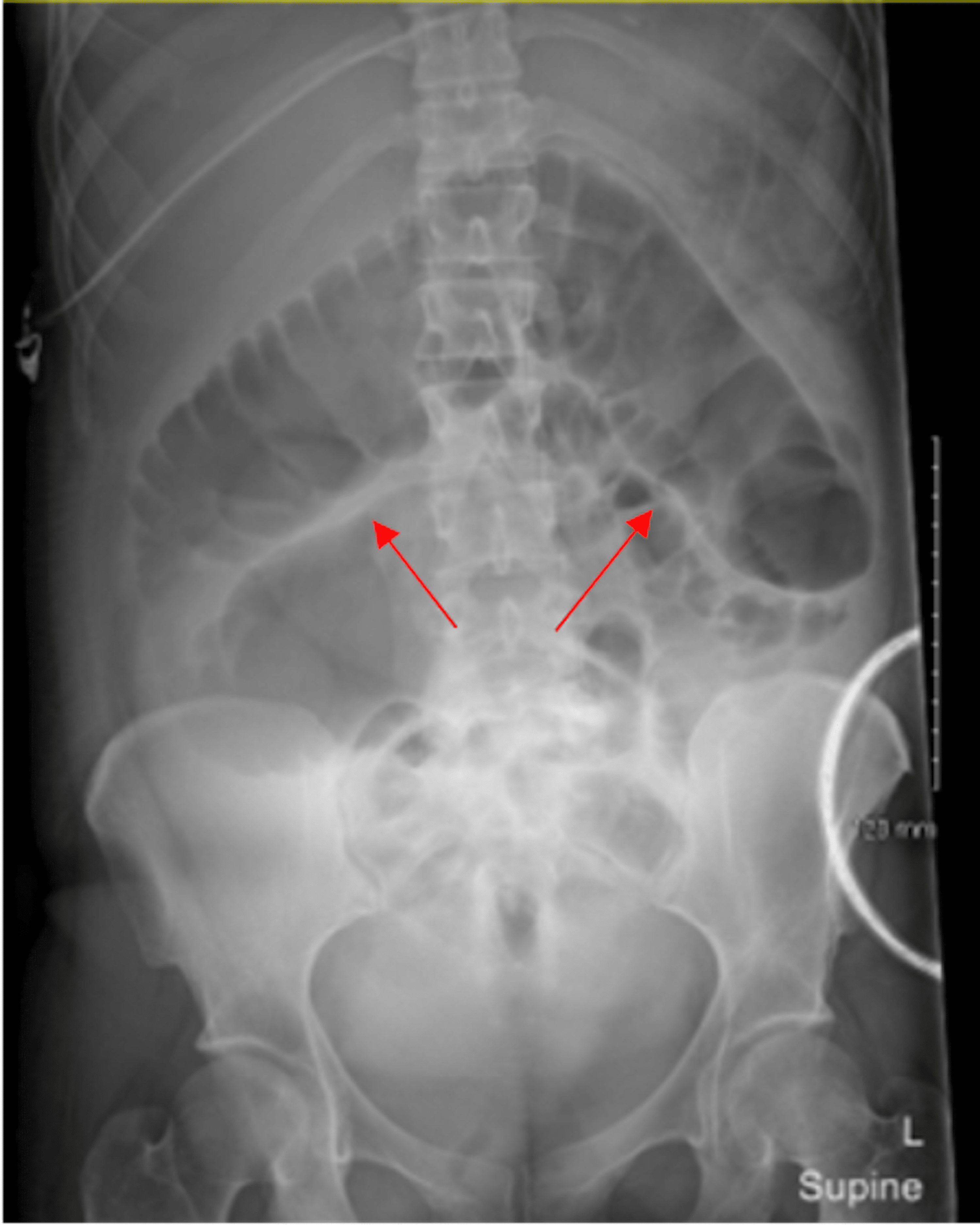 Cureus | Cecal Perforation Secondary to Large Bowel Obstruction From a ...