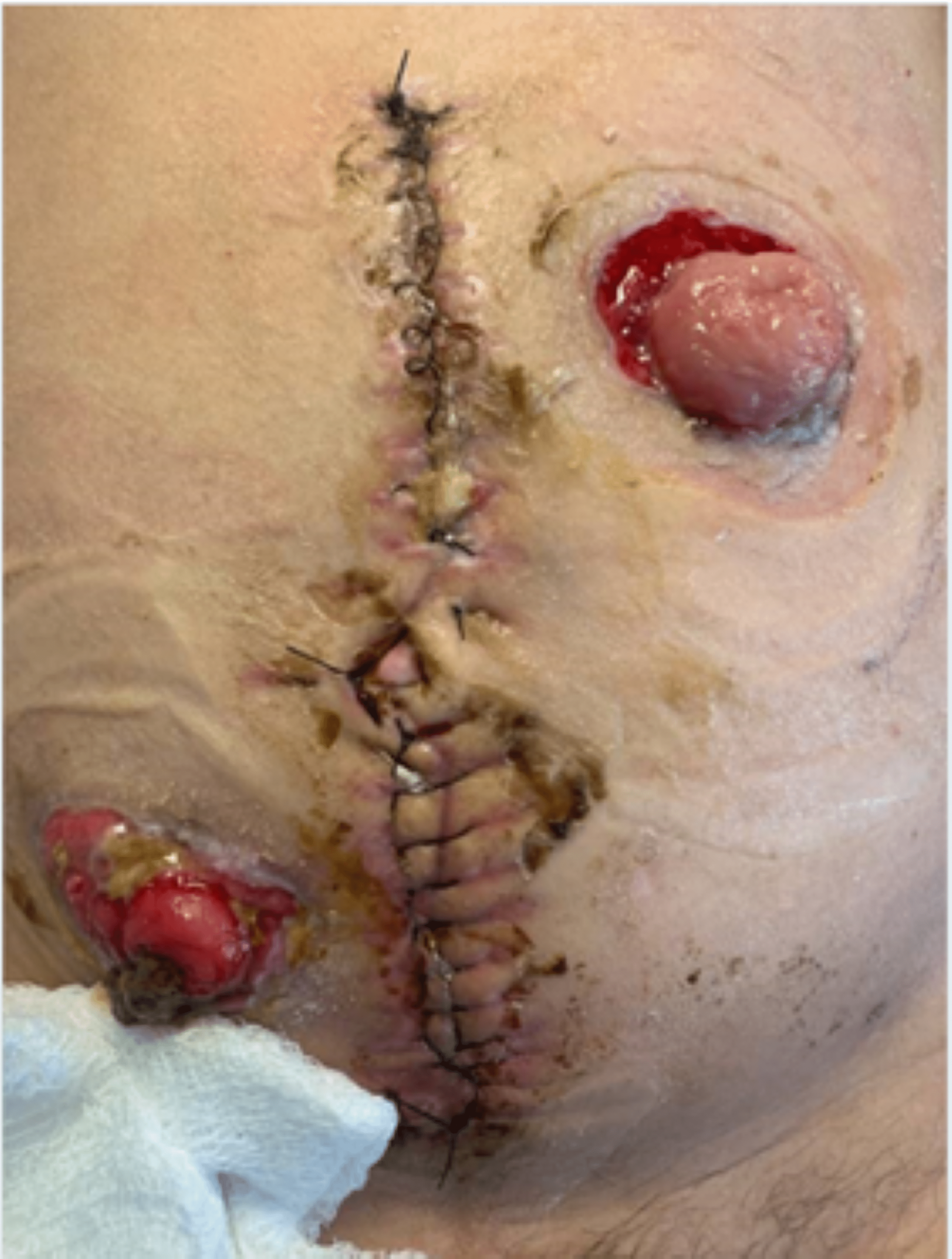 mucous fistula