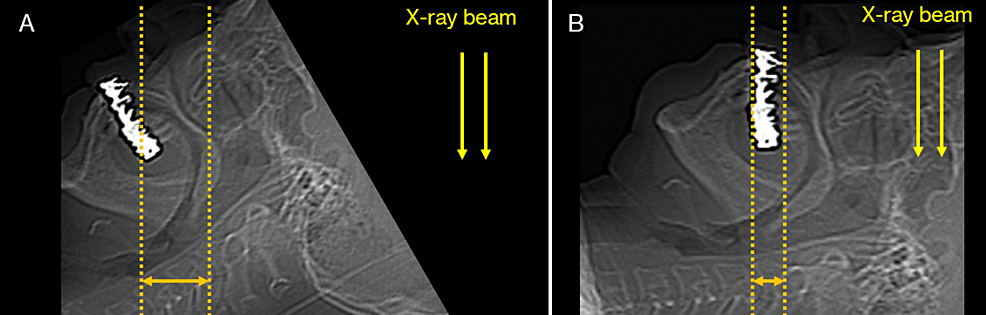 An-approach-to-reduce-the-range-of-metal-artifacts.