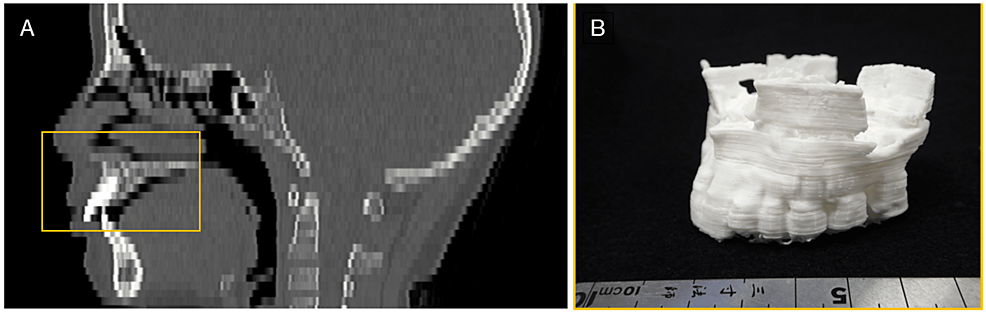 An-example-of-3D-modeling-from-DICOM-image-data-with-too-thick-slices.