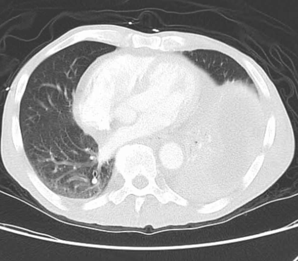 cureus-a-rare-case-of-blood-culture-negative-isolated-pulmonic-valve