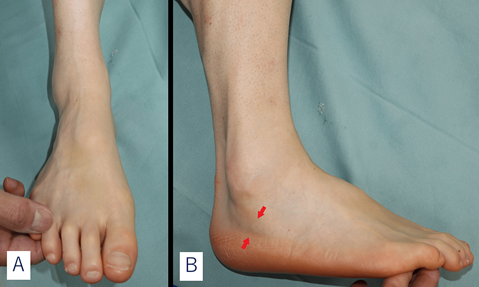 Passive ankle dorsiflexion.  Download Scientific Diagram