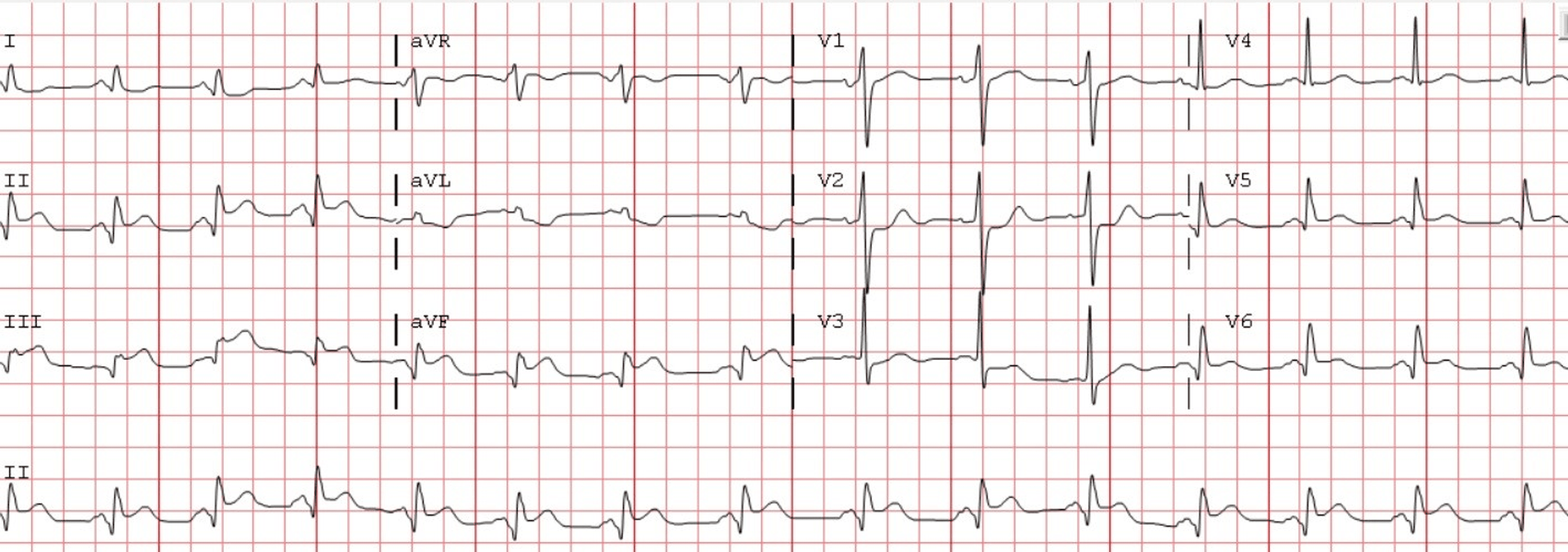 Cureus | Anomalous Origin of the Left Circumflex Coronary Artery ...