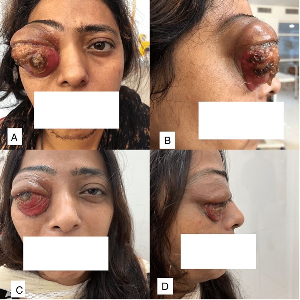 Resection of an Orbital Lymphangioma with the Aid of an Intralesional  Liquid Polymer | American Journal of Neuroradiology, image size:986x986