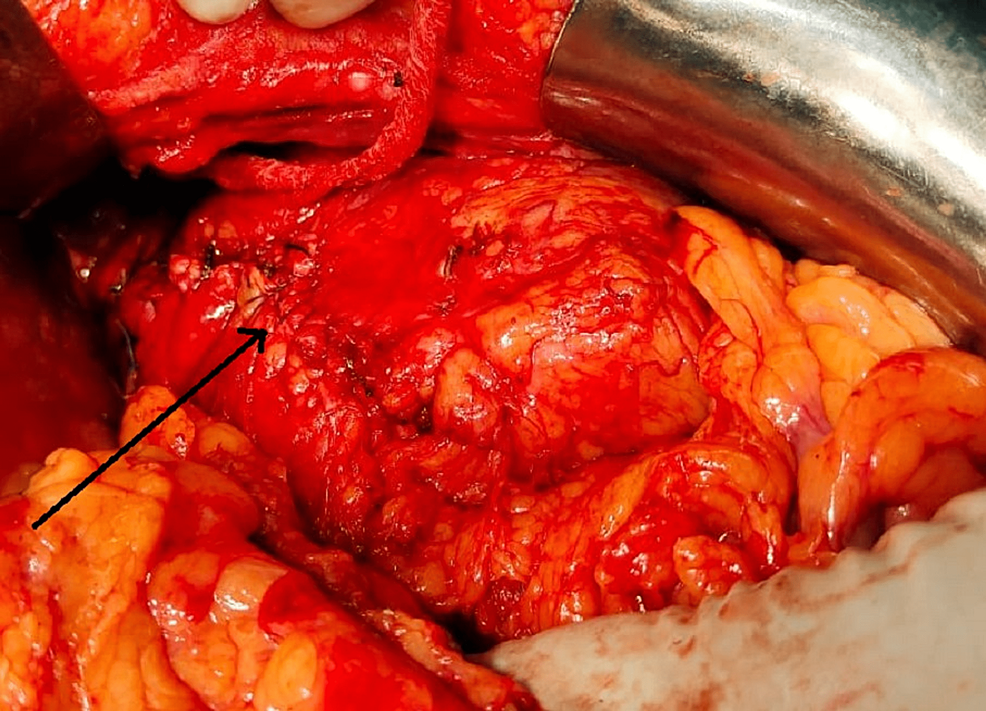 Cureus Horseshoe Kidney With a Documented Giant Calculi A Case Report