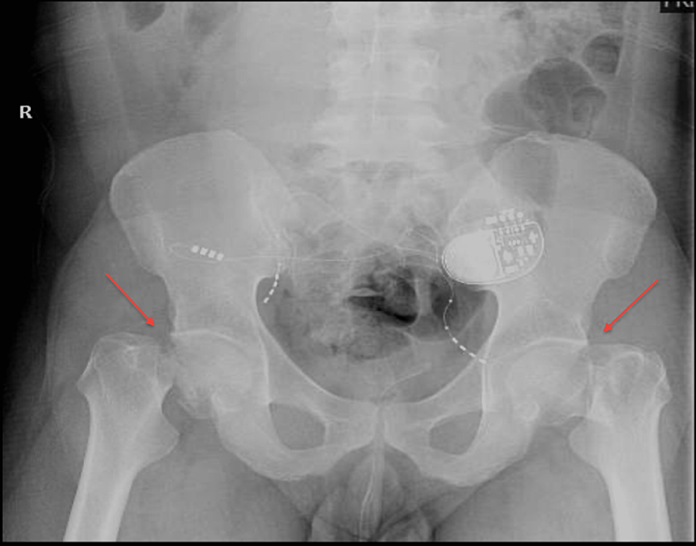 simultaneous-bilateral-neck-of-femur-fracture-after-spiritual-therapy