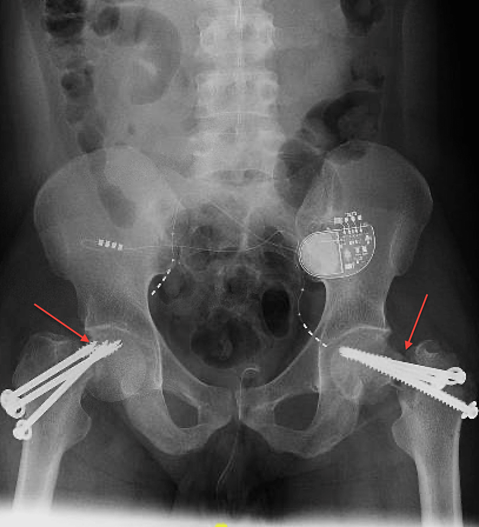 Postoperative x-ray after reduction and cannulated screws