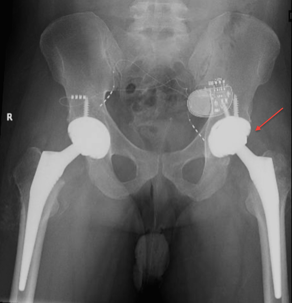 Postoperative X-ray - left side - hip arthroplasty