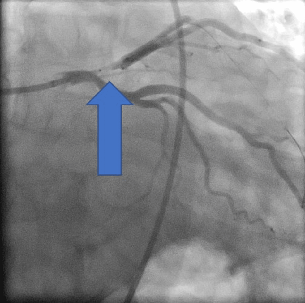 Cureus A Young Adult With Essential Thrombocythemia Presenting as