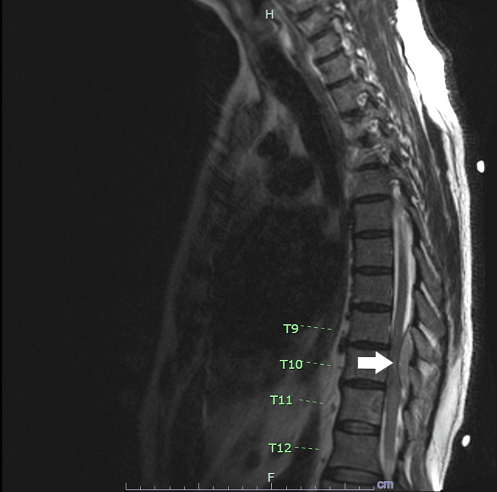 Sagittal-T2-mildly-hyperintense-and-enhancing-soft-tissue-within-the-epidural-space-at-mid-T9-extending-inferiorly-through-T12-(see-white-arrow)