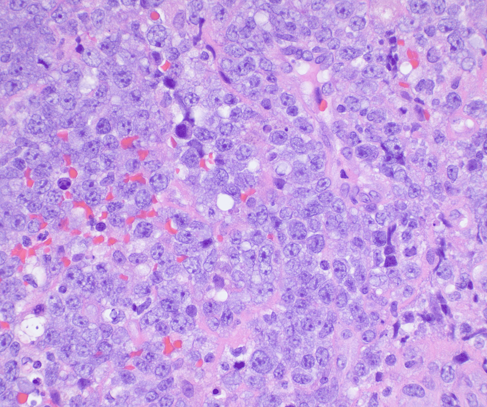 60x-magnification;-pleomorphic-tumor-cells-with-amphophilic-cytoplasm,-large-nuclei,-and-one-or-multiple-variably-prominent-nucleoli.-