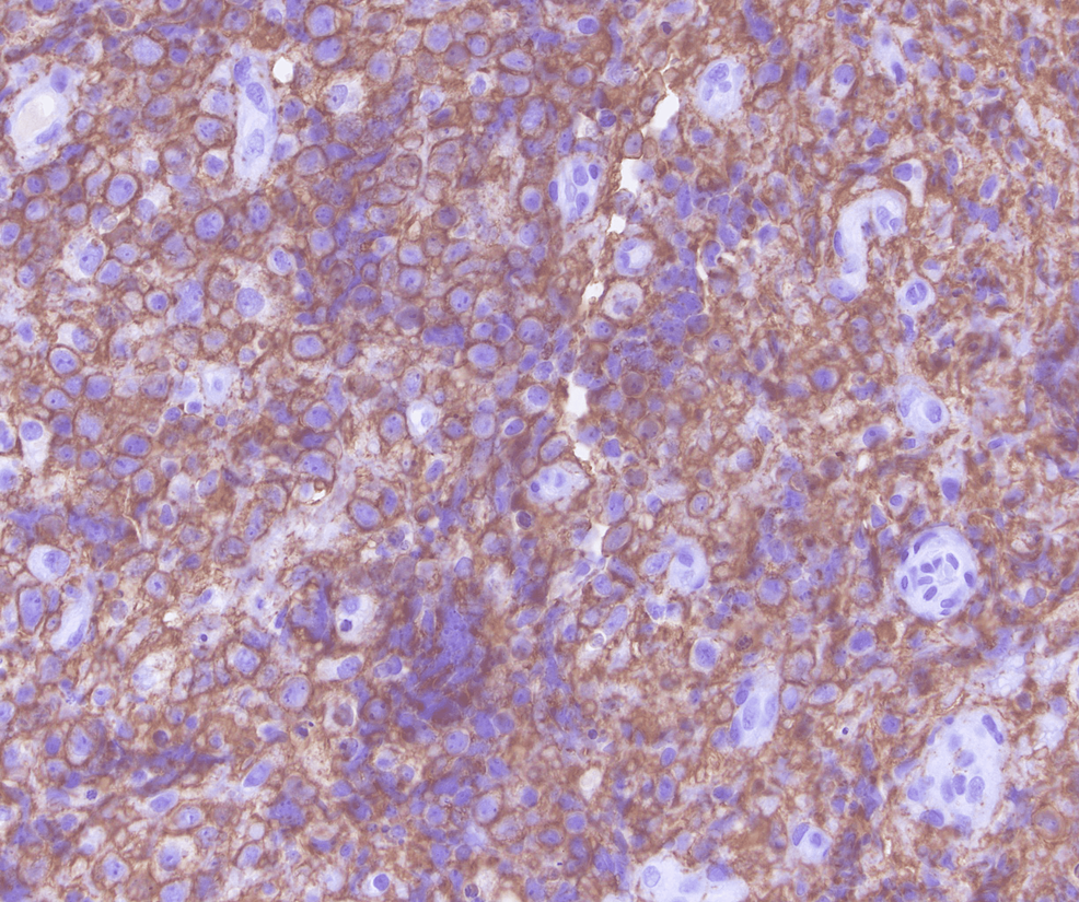 60x-magnification;-diffuse-membranous-immunoreactivity-with-CD20-in-lymphoma-cells.-