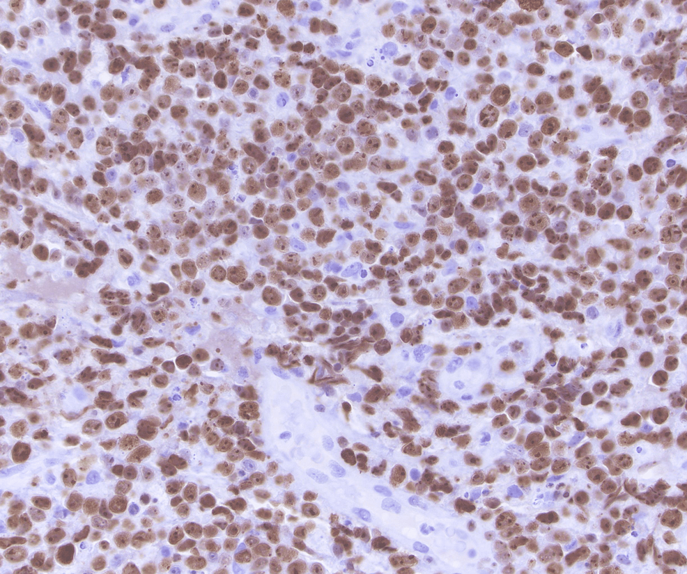 Diffuse-nuclear-immunoreactivity-for-Ki-67-in-the-majority-of-lymphoma-cells-(proliferation-index-of-around-90%).
