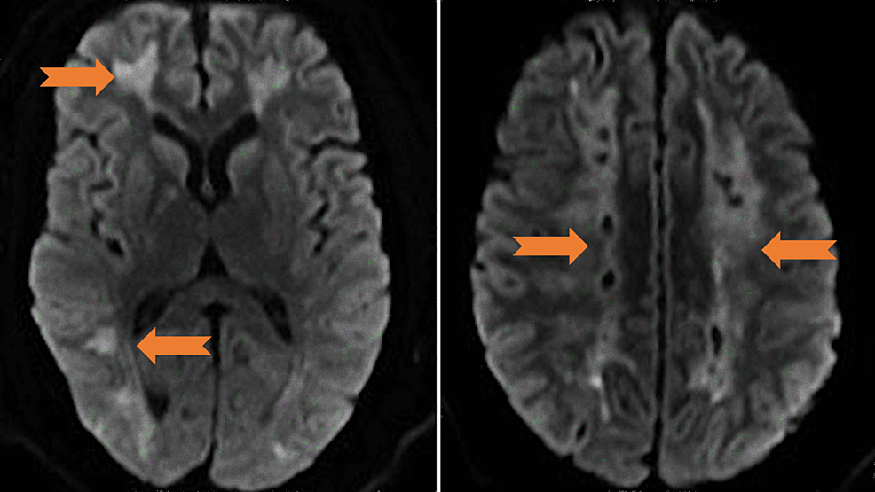 DWI-sequence-with-mild-restricted-diffusion-and-patchy-non-mass-like-enhancement-at-bilateral-subcortical-regions-without-mass-effect-(arrows).