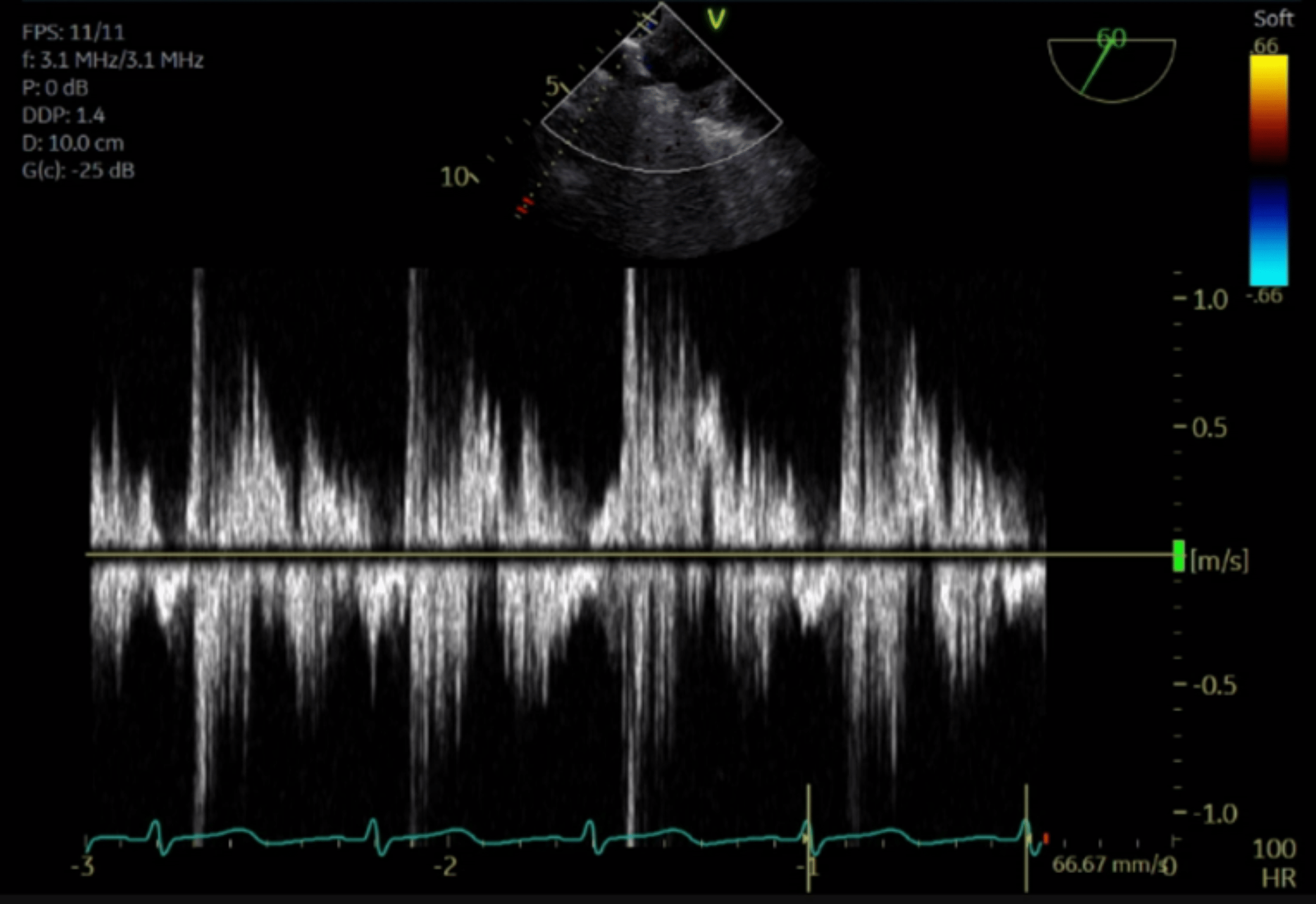 Cureus Acute Mitral Valve Regurgitation Presenting With Right Upper