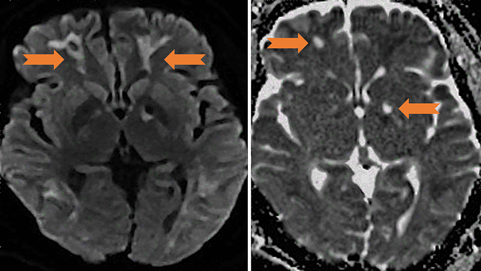 DWI-(left)-and-ADC-(right)-with-basal-ganglia,-left-more-than-right-diffusion-restriction-with-ADC-correlate-(arrows).