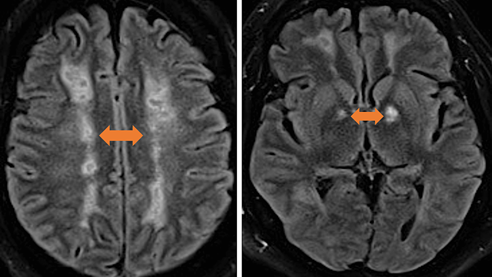 MRI-of-the-brain-T2/FLAIR-sequence-axial-images-with-confluent-white-matter-signal-abnormality-in-bilateral-frontoparietal-and-occipital-white-matter.-Multiple-small-areas-of-cystic-encephalomalacia-in-bilateral-frontal-and-parietal-deep-white-matter-and-bilateral-globus-pallidus-(arrows).
