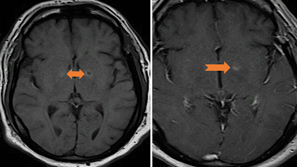 MRI-of-the-brain-T1-sequence-axial-images-with-and-without-contrast.-Mild-restricted-diffusion-and-patchy-non-mass-like-enhancement-in-portions-of-this-signal-abnormality-without-mass-effect-(arrows).
