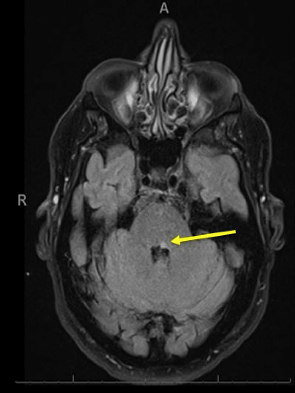 Magnetic-resonance-imaging-of-the-brain-(axial-view):-a-tiny-focus-of-restricted-diffusion-in-the-region-of-the-left-medial-longitudinal-fasciculus-which-in-this-age-group-and-context-likely-represents-a-small-acute-infarct-(yellow-arrow).