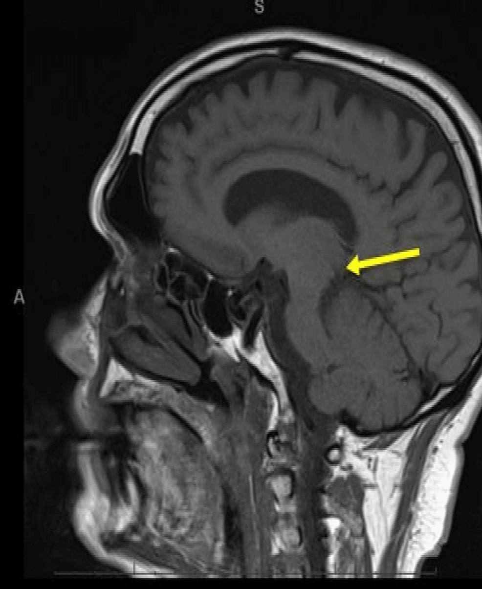 Magnetic-resonance-imaging-of-the-brain-(sagittal-view):-re-demonstration-of-restricted-diffusion-in-the-left-paramedian-tegmentum-on-diffusion-weighted-imaging-(yellow-arrow).