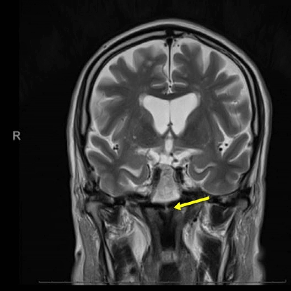 Magnetic-resonance-imaging-of-the-brain-(coronal-view):-re-demonstration-of-restricted-diffusion-in-the-left-paramedian-tegmentum-(yellow-arrow).