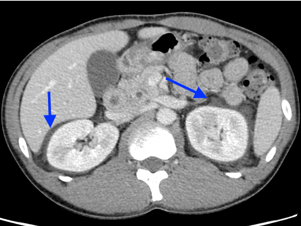 Edematous-findings-around-both-kidneys-(blue-arrows)