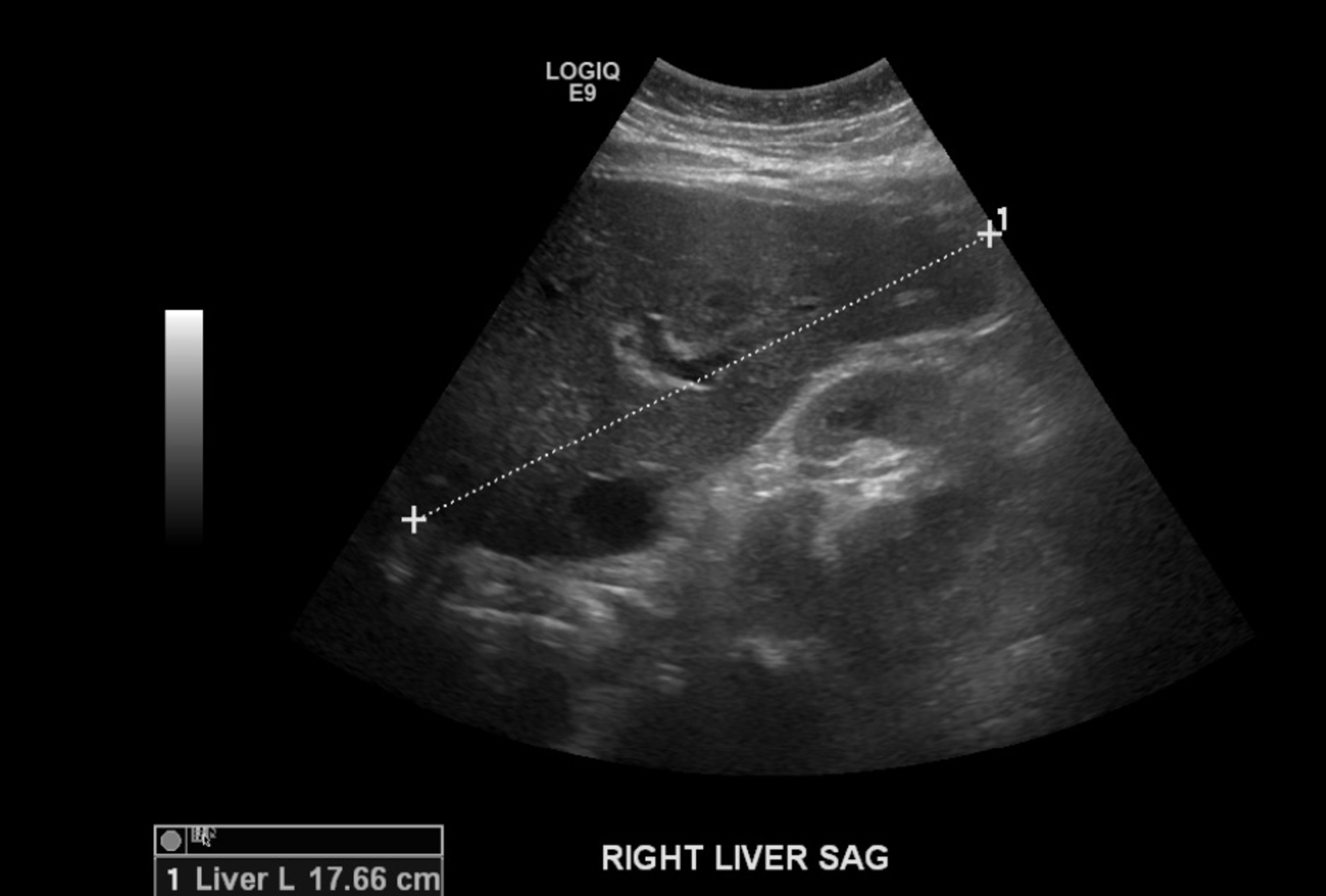 Cureus A Rare Case of Ibuprofeninduced Acute Liver Injury