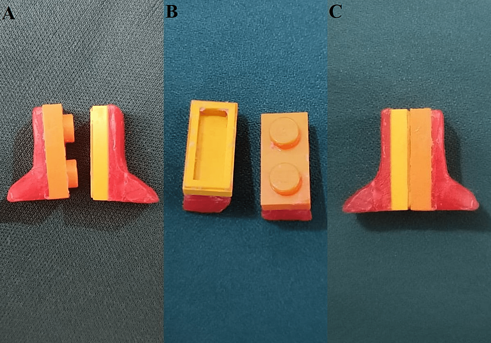 Cureus Custom Sectional Impression Tray With Sectional Handle for Microstomia Patients