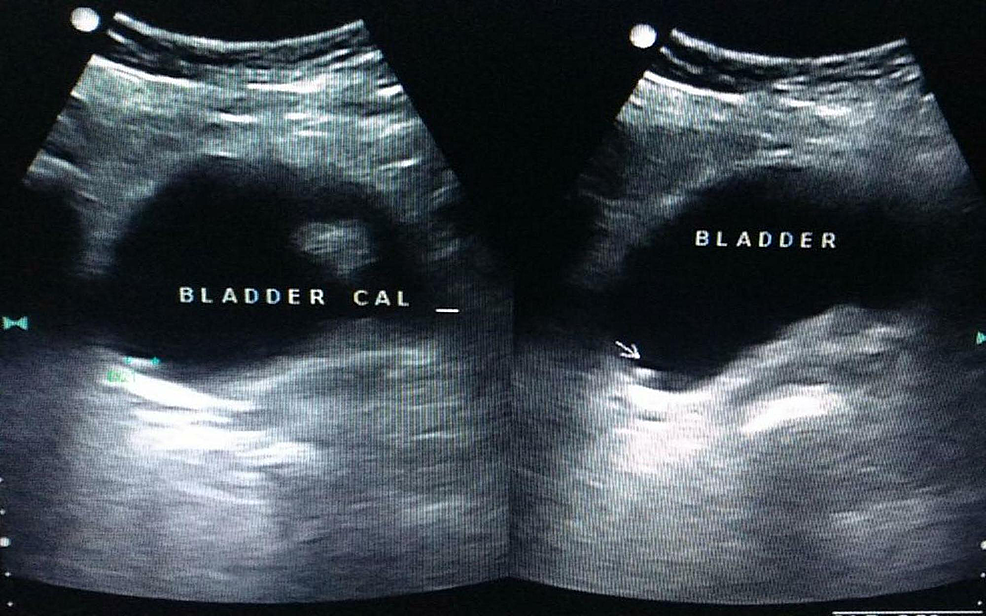 cureus-primary-vesical-amyloidosis-masquerading-as-vesical-calculus