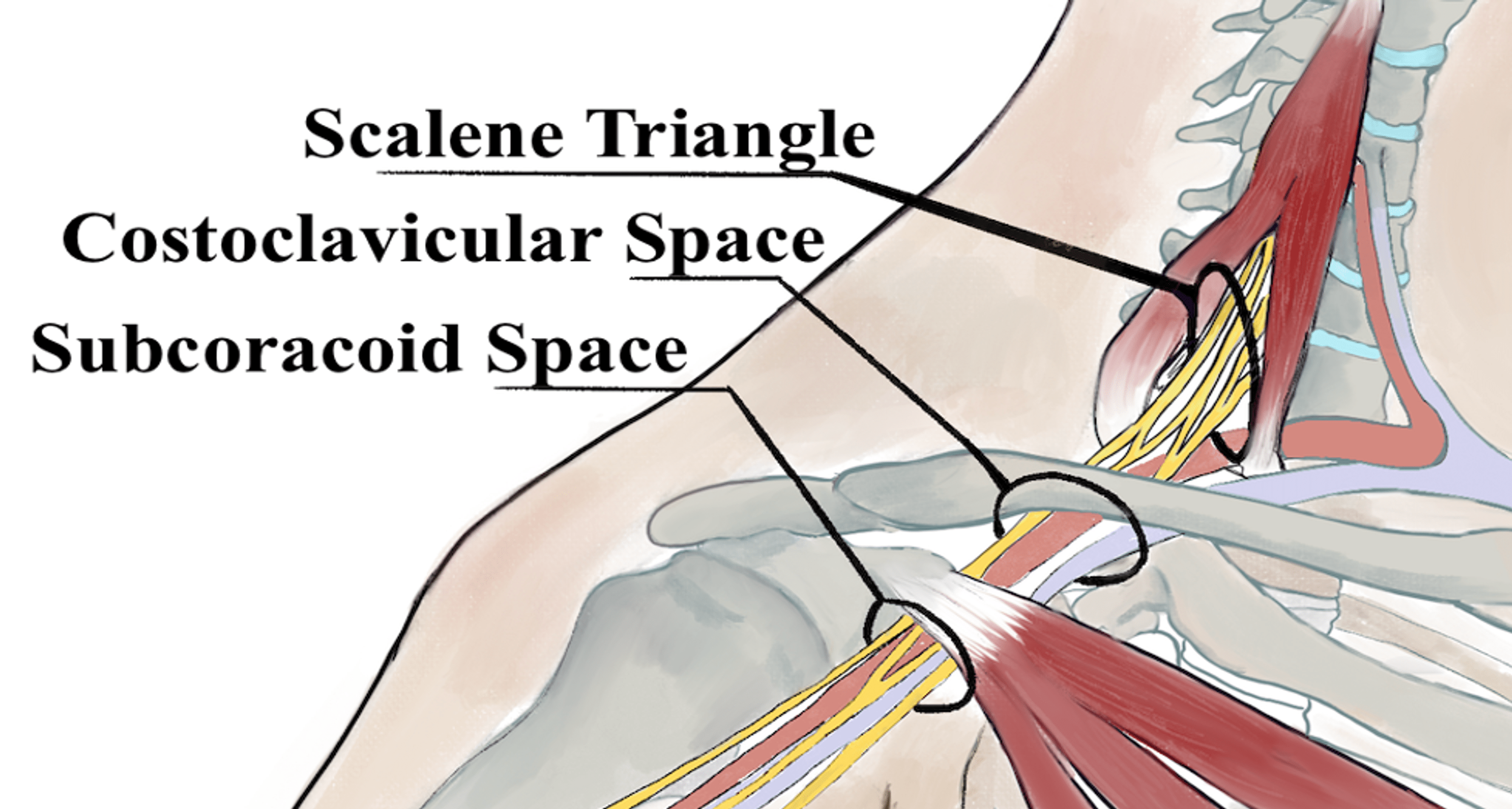Cureus Hydrodissection for the Treatment of Vascular Thoracic Outlet