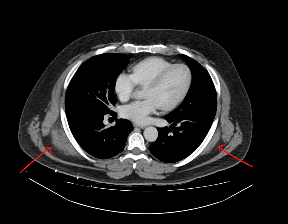 Cureus | Management of Symptomatic Elastofibroma Dorsi: A Case Report ...