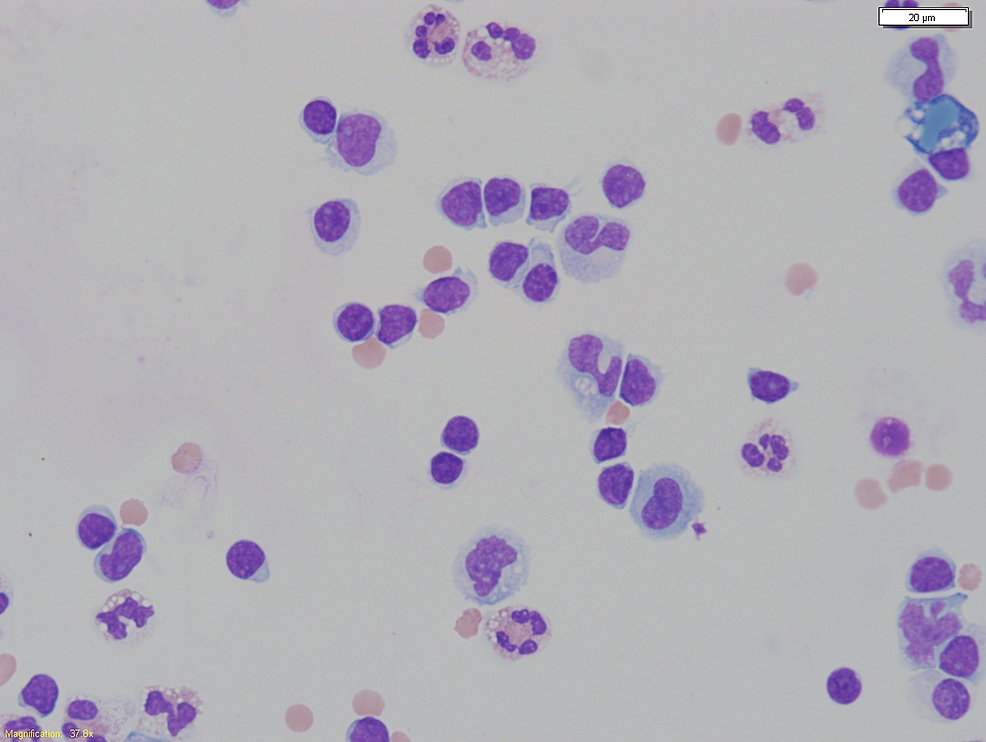 Cureus Noninfectious Cloudy Peritoneal Effluent in a Peritoneal
