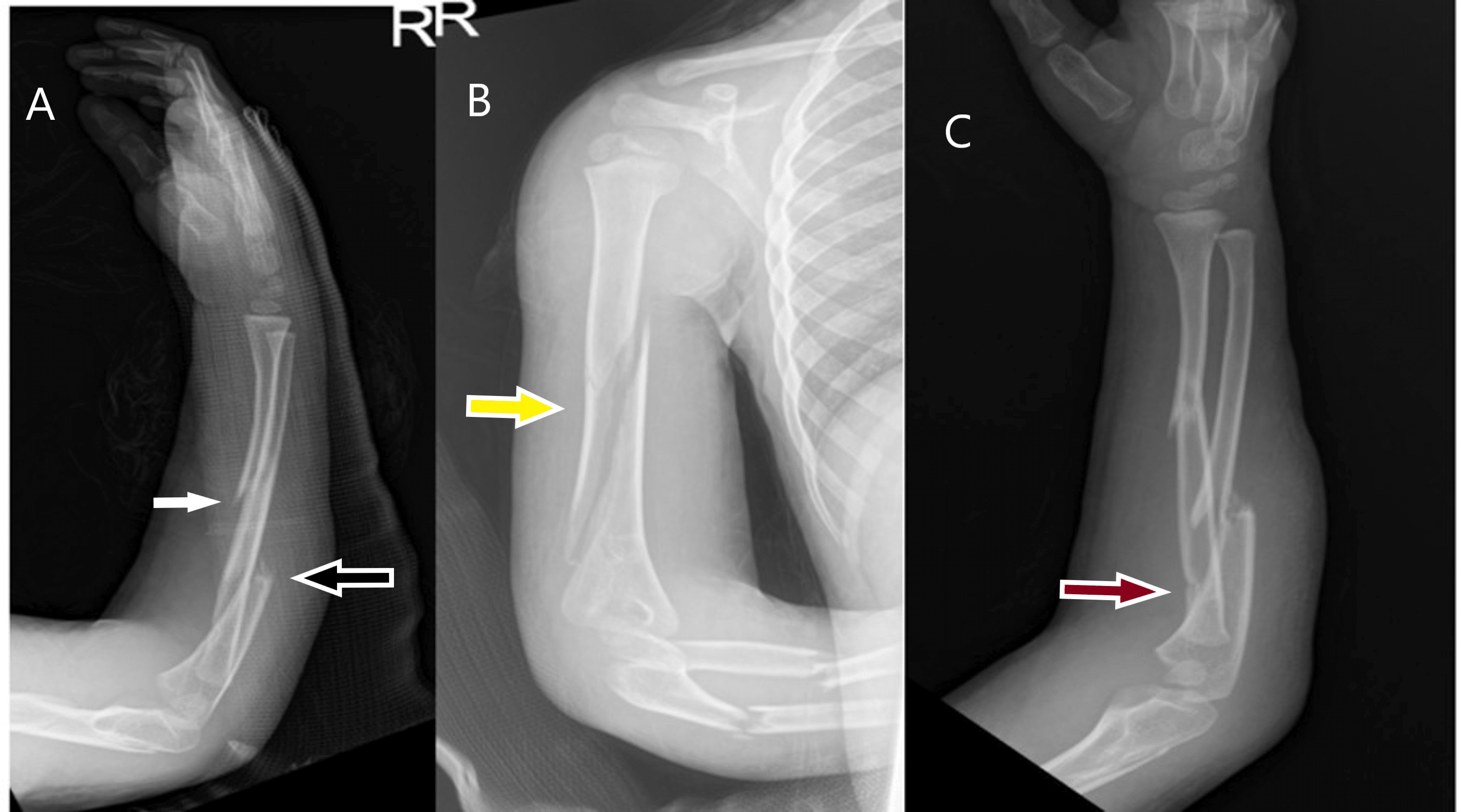 Cureus Pediatric Floating Elbow Caused by a Novel Mechanism A Case