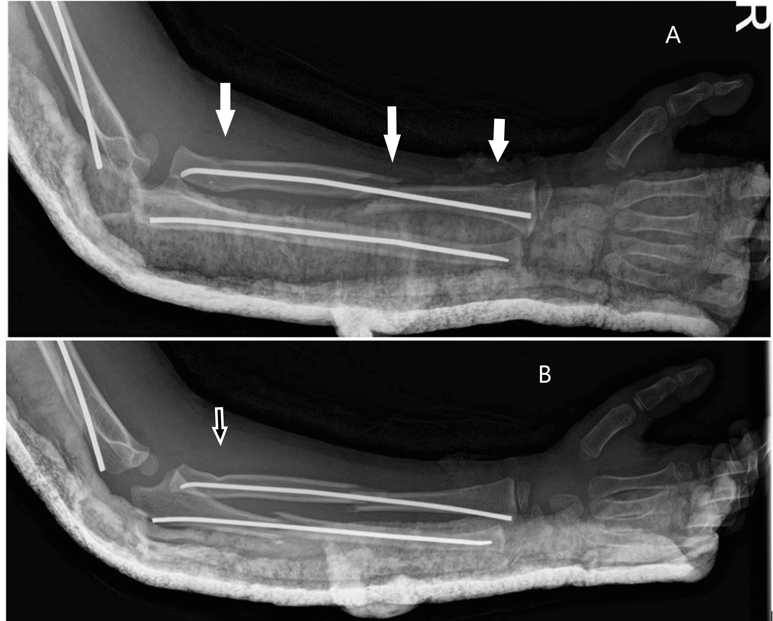 Cureus Pediatric Floating Elbow Caused by a Novel Mechanism A Case