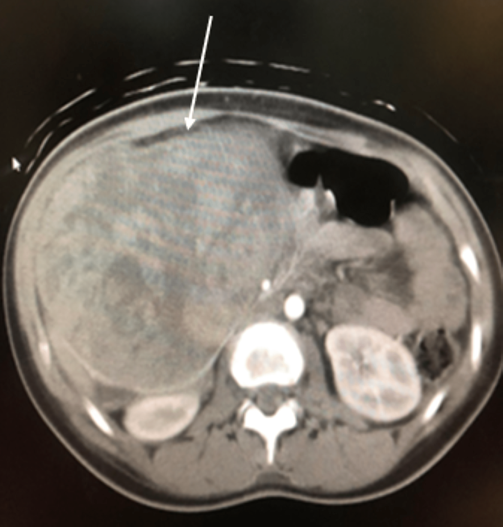 Single-axial-slice-of-the-CECT-demonstrating-a-larger-heterogenous-retroperitoneal-mass-(white-arrow).