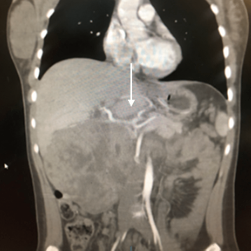 Single-coronal-slice-of-the-retroperitoneal-mass-in-addition-to-the-presence-of-a-replaced-left-hepatic-artery-arising-from-the-left-gastric-artery-(white-arrow).