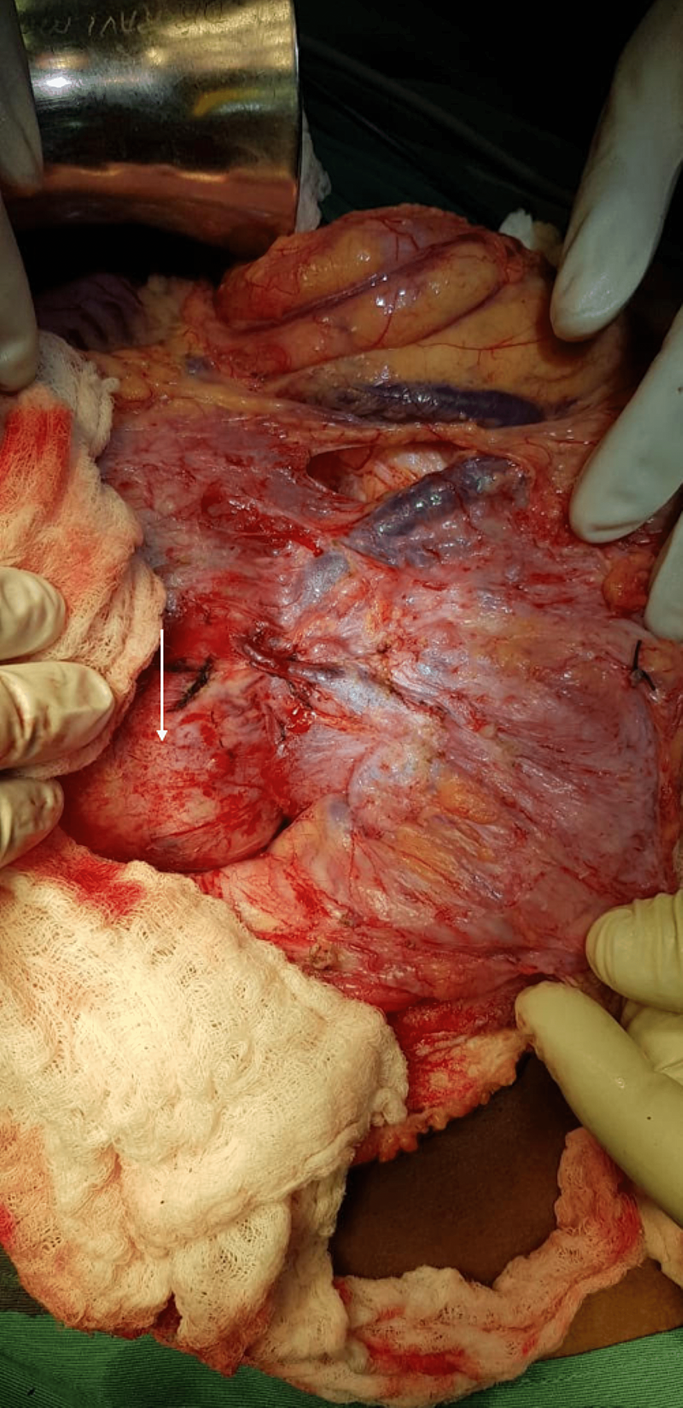 Demonstration-of-engorged-mesocolic-veins-and-impression-of-the-retroperitoneal-mass-(white-arrow).
