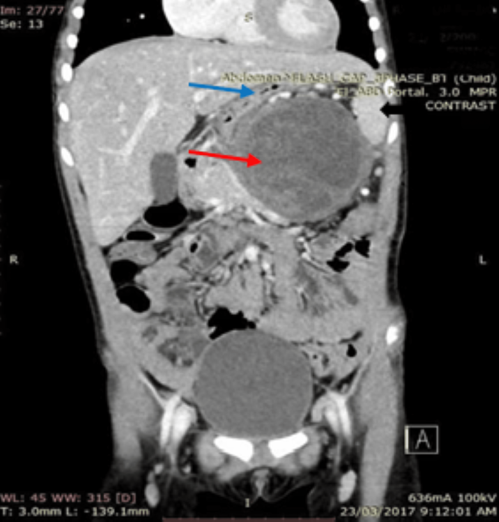 Cystic-mass-(red-arrow)-in-the-distal-pancreas-and-its-relationship-to-the-spleen-(black-arrow)-and-the-stomach-(blue-arrow).