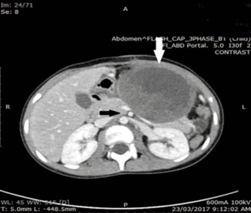 Pancreatic-cystic-mass-(white-arrow)-arising-from-the-body-and-tail-of-the-pancreas.-The-SMV-and-SMA-were-not-encased-(black-arrow).